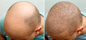 Hair Transplant Istanbul: Where Innovation Meets Experience