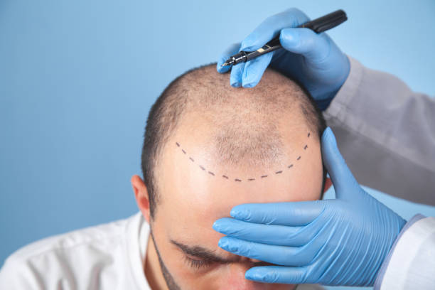 How Much Is Hair Transplant for Natural Results?