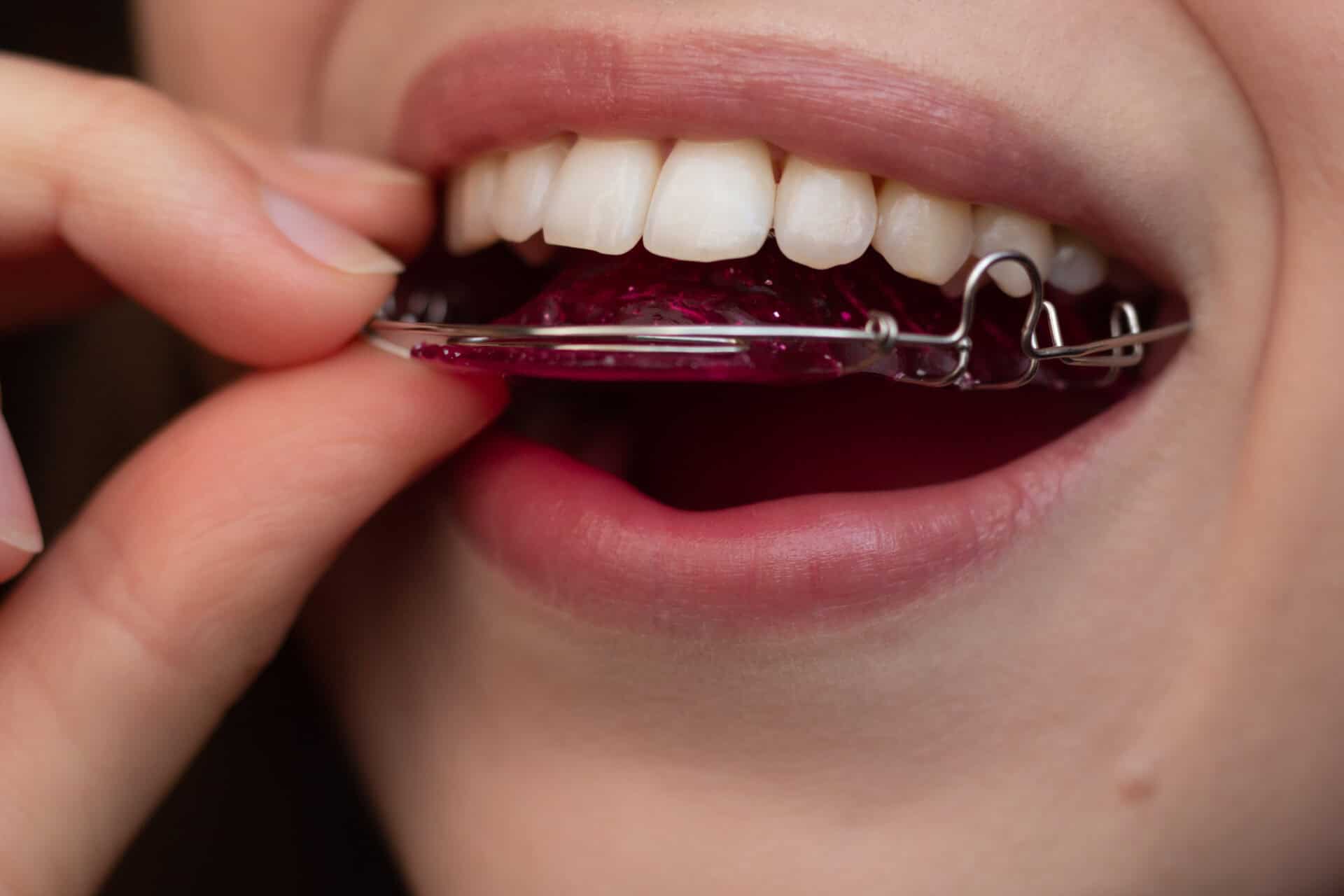 Ceramic Braces vs Metal Braces: Which Is Better for You?